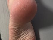 Peeling stóp